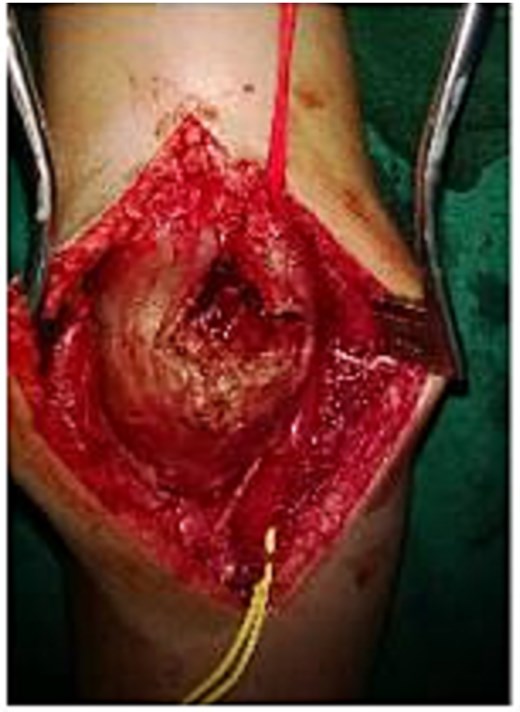 Intraoperative view of the surgical field.