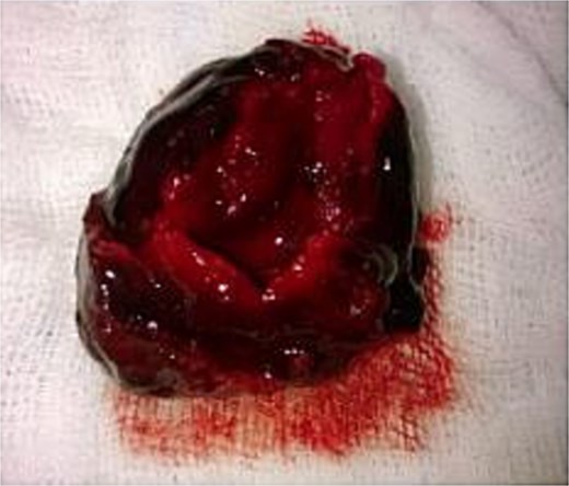 Excised pseudoaneurysm sac.