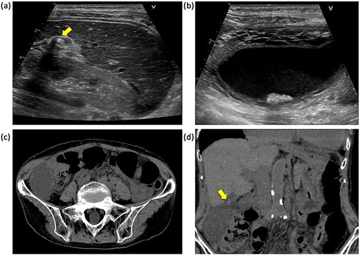 Abdominal ultrasonography and CT findings. (a) Impacted gallstone in the gallbladder neck (arrow). (b) Enlarged gallbladder and edematous thickening of the gallbladder wall. (c) Enlarged gallbladder in the right lower abdominal quadrant. (d) Enlarged gallbladder and gallstone in the neck of the gallbladder (arrow).