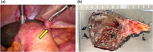 Surgical images and removed gallbladder. (a) Discolored gallbladder and twisted cystic duct (arrow). (b) Surgical specimen.