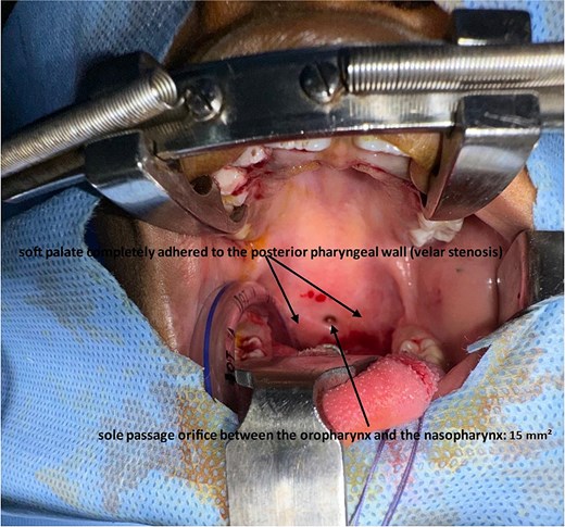 Intraoperative view showing severe velopharyngeal stenosis with complete adhesion between the soft palate and the posterior pharyngeal wall, leaving only a small central opening estimated at approximately 15 mm2 (arrow).