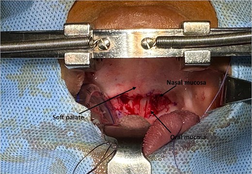 The intraoperative view following the release of the soft palate stenosis from the posterior wall of the oropharynx, illustrating the distinction between the nasal and oral mucosa of the soft palate.