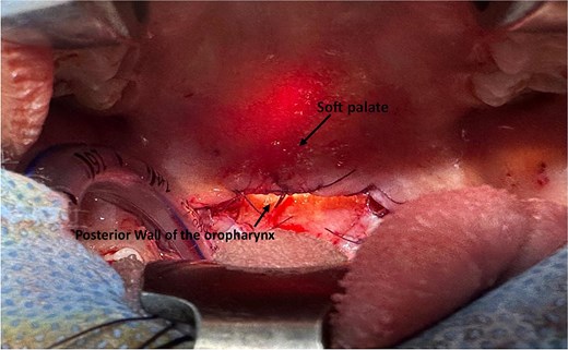 Intraoperative view showing the final result after reconstruction of the soft palate.