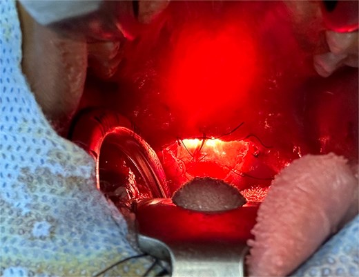 Intraoperative view confirming the patency of the upper aerodigestive tract via oral and nasal endoscopic approaches.