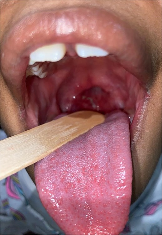 Two-month postoperative follow-up image showing favorable anatomical and functional outcome of the soft palate and oropharynx.
