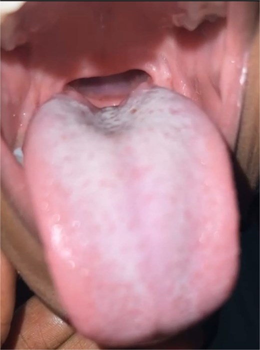 The follow-up image of the soft palate and oropharynx at 10 months post-intervention demonstrates satisfactory anatomical and functional progress.