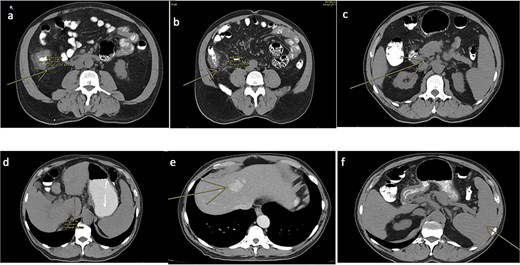 CT scan of the abdomen and pelvis (non-contrast). (a) Tumoral concentric thickening of the cecum with pericolic and mesenteric fat stranding. (b) Infiltrative-appearing lymphadenopathy adjacent to the tumor. (c) Retroperitoneal lymphadenopathy. (d) Signs of chronic liver disease and portal hypertension. (e) Hepatic hemangioma. (f) Splenomegaly.