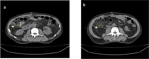 Abdominal CT scan (non-contrast). (a) Anastomotic staples and drain trajectory. (b) Presence of free intraperitoneal fluid.