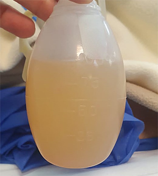 Image of chylous ascitic fluid collected through the abdominal drain, showing its characteristic milky appearance.
