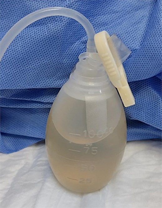 Image of ascitic fluid on day 5 of hospitalization, showing clearer appearance indicating reduced chyle content.