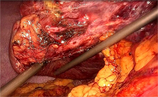 Laparoscopic view showing adhesiolysis and mobilization of the right liver lobe with identification of the locking clip on the margin of the previous S6 hepatectomy. Dense adhesions are visible at the resection site, requiring careful dissection to locate the previously placed hemostatic clip.