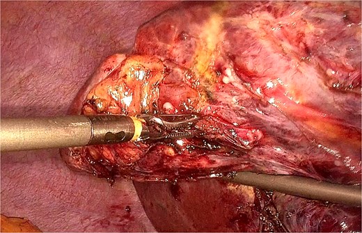 Close-up laparoscopic view demonstrating precise identification of the locking clip that will serve as the traction element. The clip maintains its structural integrity and positioning 3 years after the initial hepatectomy, providing an ideal anchor point for liver manipulation.