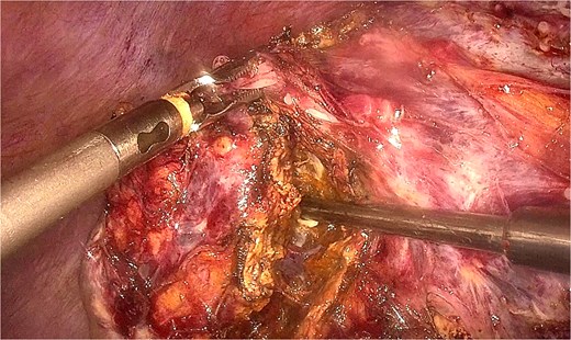 Demonstration of multidirectional liver manipulation using the repurposed locking clip as a traction element. The clip allows 360° manipulation of the liver segment, providing optimal exposure of the recurrent lesion and surrounding structures during dissection.