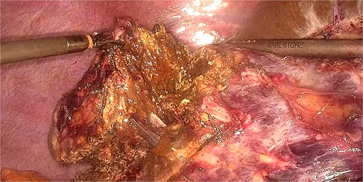Laparoscopic view showing how the clip-assisted traction optimally exposes the vascular structures requiring ligation during the re-resection. The enhanced visualization allows for safe identification and control of hepatic vessels while maintaining adequate surgical margins around the recurrent metastasis.