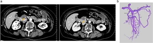 (a) Preoperative contrast-enhanced CT in the portal venous phase demonstrated a hypovascular tumor measuring 20 mm in the pancreatic uncinate process and mild improvement in SMV narrowing (arrow, pre-NAC in left image, post-NAC in right image). (b) Preoperative 3D imaging demonstrated that the jejunal veins were discontinued separately, and there are three collateral pathways, via posterior superior pancreaticoduodenal vein, inferior mesenteric vein through the right gastroepiploic vein, and stenotic SMV with intramesenteric anastomoses. SMV: Superior mesenteric vein, NAC: Neoadjuvant chemotherapy.