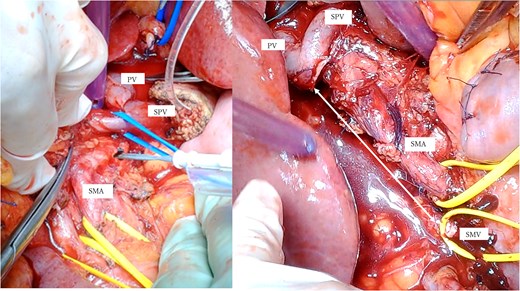 (a) Intraoperative photographs: Hemicircumferential dissection of the SMA nerve plexus, followed by en bloc SMV resection. (b) The SMV was transected proximal to its junction with the splenic vein. The SMA and SMV are encircled with vessel loops. The photograph illustrates the considerable gap between the SMV transection site and the jejunal branch stump (double-headed arrow). SMA: Superior mesenteric artery, SMV: Superior mesenteric vein.