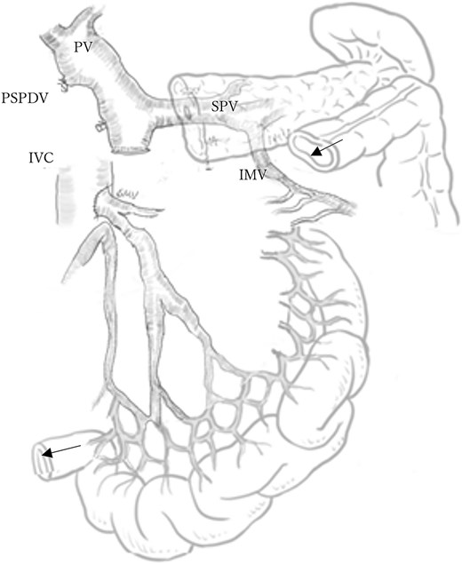 Schematic of mesocaval shunt and hepatic blood flow via collateral pathways. The arrows indicate the splenic flexure of the colon and the terminal ileum, which are scheduled for anastomosis. PV: Portal vein, SPV: Splenic vein, PSPDV: Posterior superior pancreaticoduodenal vein, IVC: Inferior vena cava, IMV: Inferior mesenteric vein.