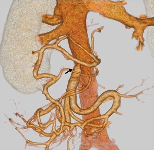 Postoperative contrast-enhanced CT: An arrow indicates patent mesocaval shunt (on postoperative day 14).
