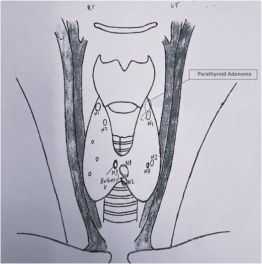 Preoperative ultrasound cervical mapping. Nodular lesions with suspicious sonographic features in both thyroid lobes. The lesions N1 and N3 in the isthmus were classified as Bethesda III and V, respectively. The parathyroid adenoma is marked behind the left upper lobe.