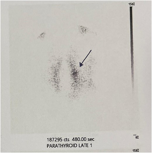 99mTc sestamibi scan. Focal radiotracer uptake in the left upper parathyroid gland region (pointed by the arrow), persisting on delayed images, consistent with a parathyroid adenoma.