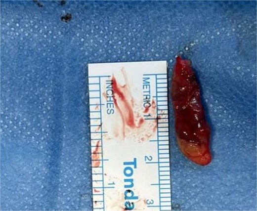 Resected left upper parathyroid gland. Well-circumscribed, reddish-brown to tan, oval mass, consistent with a typical parathyroid adenoma.