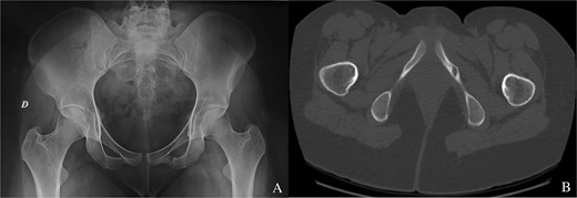 (A) Osteoid osteoma of the left ischiopubic ramus on the anteroposterior view of a pelvic X-ray. (B) Osteoid osteoma of the left ischiopubic ramus on an axial section of the CT scan of the pelvis.