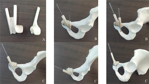 (A) Two customized 3D-printed drill guides for more precision. (B) A customized 3D-printed drill guide with two K-wires positioned in the direction of the tumour. (C) A customized 3D-printed drill guide with one K-wire positioned in the direction of the tumour.