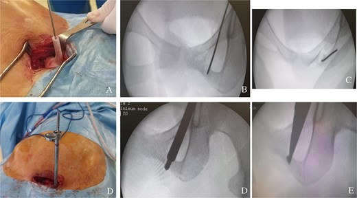 (A) Positioning the guide on the iliopubic ramus via a mini-Pfennestiel approach. (B) Anteroposterior fluoroscopic control of the correct position of the K-wire in the tumour. (C) Fluoroscopic inlet view showing the correct position of the K-wire in the tumour. (D) A soft tissue protection instrument as a guide for the cannulated drill. (E) Curettage of the tumour.