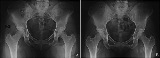 (A) Immediate anteroposterior pelvis X-ray showing the tumour resection. (B) Last follow-up anteroposterior pelvis X-ray showing the absence of tumour recurrence.