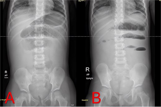 Admission abdominal radiographs (composite). (A) Supine abdominal X-ray on presentation demonstrating central small-bowel dilation and paucity of distal gas. (B) Upright abdominal X-ray on presentation showing multiple small-bowel air-fluid levels without free air.