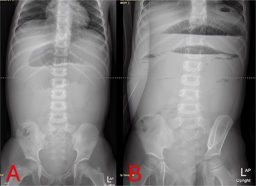Twenty-four-hour follow-up abdominal X-rays. (A) Supine view 24 hours postadmission with persistent small-bowel distension. (B) Upright view 24 hours postadmission confirming ongoing air–fluid levels and no colonic gas.