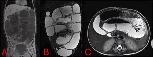 MRI of the abdomen—identification of obstruction cause. (A) Coronal T2-weighted MRI showing multiple fluid-filled, dilated small-bowel loops and a focal right lower quadrant transition point. (B) Axial T2-weighted MRI demonstrating a periappendiceal abscess with mesenteric edema compressing adjacent ileal loops. (C) Sagittal MRI view highlighting appendiceal abscess boundaries and a possible appendicolith.