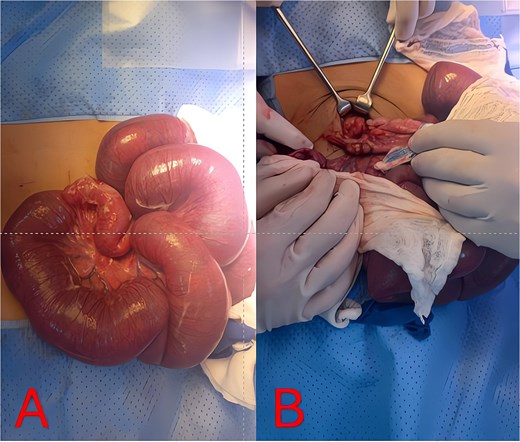 Intraoperative findings and resolution. (A) Intraoperative photo of markedly distended, congested small-bowel loops exteriorized at laparotomy. (B) Intraoperative view of the perforated appendix and surrounding abscess/adhesions tethering the distal ileum, causing mechanical obstruction.