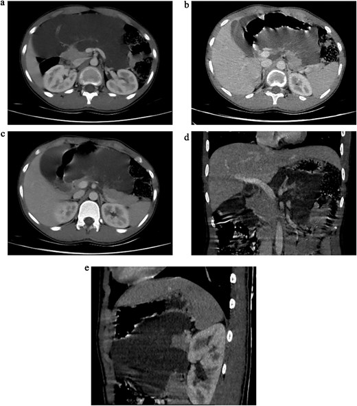 (a) Axial sections of CT abdomen (arterial phase) showing cystic mass in relation to pancreas. (b) Axial sections of CT abdomen (arterial phase) showing cystic mass in relation to pancreas. (c) Axial sections of CT abdomen (venous phase) showing cystic mass in relation to pancreas. (d) Coronal section of CT abdomen (venous phase) showing cystic mass in relation to body and tail of the pancreas. (e) Sagittal section of CT abdomen (venous phase) showing cystic mass in relation to body and tail of the pancreas.