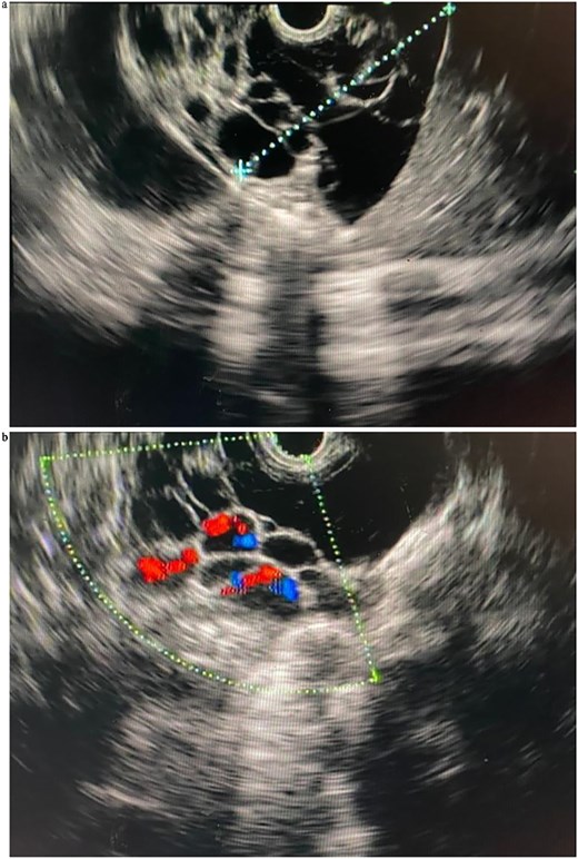 (a) Linear EUS (Olympus ME 1) views of the pancreatic lymphangioma, seen as cystic lesions in the pancreatic parenchyma. (b) Linear EUS (Doppler) (Olympus ME 1) views of the pancreatic lymphangioma, seen as cystic lesions in the pancreatic parenchyma.
