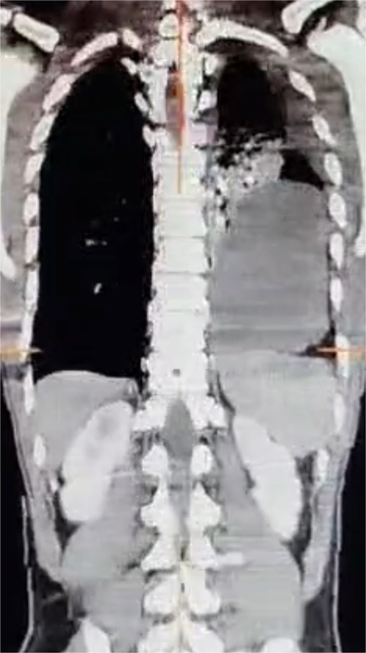 Contrast-enhanced CT scan showing an 8 cm left posterolateral diaphragmatic defect with herniation of the splenic flexure and omentum into the left thoracic cavity.