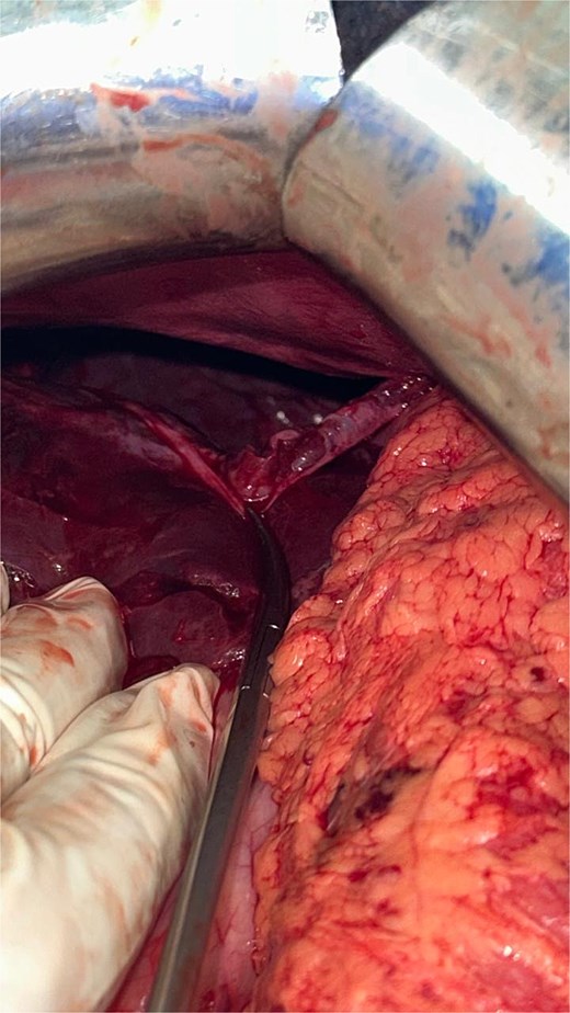 Intraoperative view showing a full-thickness diaphragmatic rupture at the left posterolateral hemidiaphragm after reduction of the herniated contents.