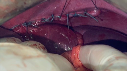 Surgical repair of the diaphragmatic defect using interrupted non-absorbable sutures.