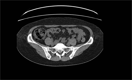 Dilated tubular structure with signs of fat stranding suggesting appendicitis.