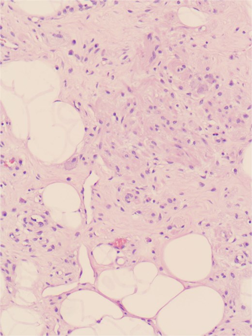 Nerve-like spindle cells and fibrous obliterations suggesting features of an appendicular neuroma.