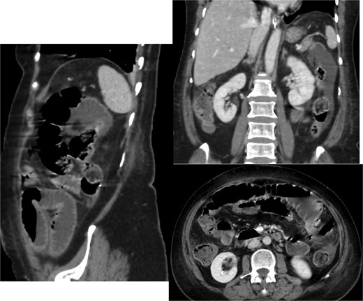 Contrast-enhanced CT scan of the abdomen and pelvis showing the small bowel loops are dilated reaching up to 35 mm. There is a transition zone with 22 mm gallstone in the distal ileum with distally collapsed ileal segments and collapsed large bowel loops representing high-grade obstruction. The gallbladder appears irregular with thickened wall and significant surrounding fat stranding. There is a fistula between the gallbladder and the second part of the duodenum.