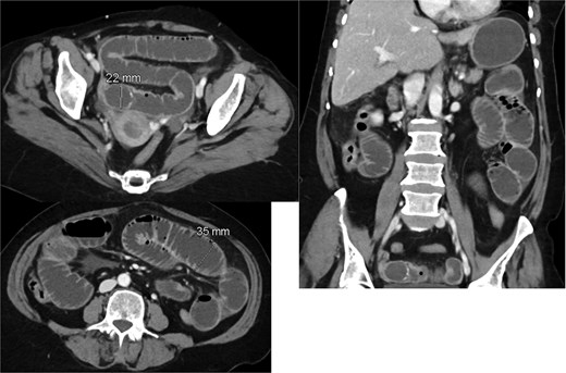 Interval passage of the previously small bowel obstructing gallstone seen now at the mid descending colon with proximal colonic distention however no signs of mechanical bowel obstruction. The small bowel loop is dilated and fluid-filled without definite transition zone; there is associated mild small bowel thickening, findings are likely representing postoperative changes.