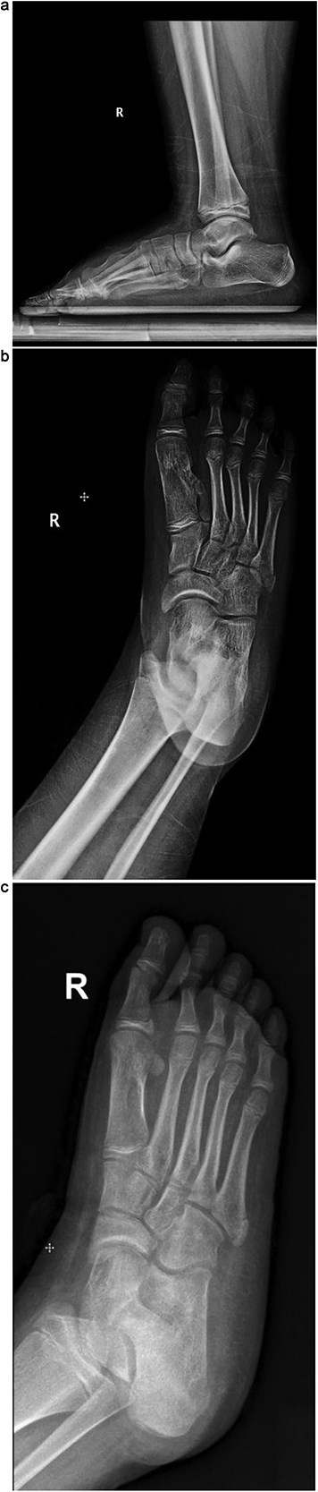 (a) Lateral radiograph of the right foot demonstrating a bony mass extending from the medial cuneiform to the first metatarsal. (b) Oblique radiograph of the right foot highlighting the abnormal bony outgrowth between the first and second metatarsals. (c) Anteroposterior radiograph showing a bony mass arising from the medial cuneiform extending toward the first metatarsal, with widening of the first intermetatarsal space.