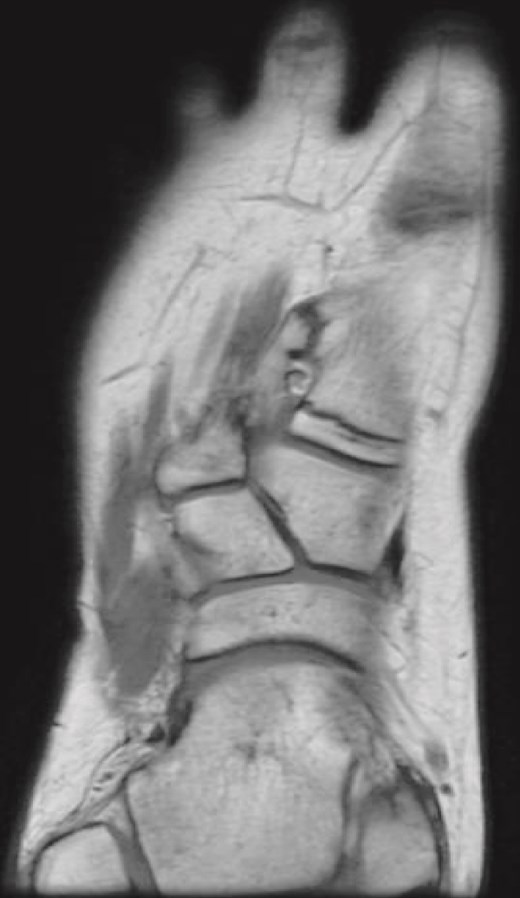 Coronal T1-weighted MRI of the right foot showing a rudimentary bone interposed between the first and second metatarsals with pseudo-articulation and ankylosis with the midshaft of the first metatarsal.