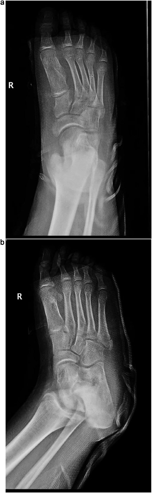 (a) Postoperative anteroposterior radiograph of the right foot demonstrating complete resection of the intermetatarsal lesion and normalization of the intermetatarsal spacing. (b) Oblique postoperative view confirming successful removal of the mass with preserved alignment of the first metatarsal and surrounding structures.