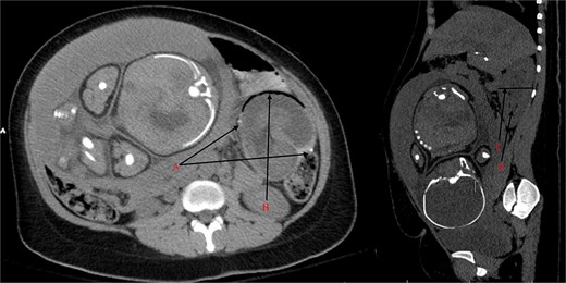 (A) Staple line of the jejunojejunostomy anastomosis. (B) Pneumatosis intestinalis from the ischemic intussusceptum. (C) Cross-section of the intussuscipiens measuring up to 6.3 cm (n ≈ 3 cm). (D) Mesenteric vessels in the lumen on the intussucipiens.