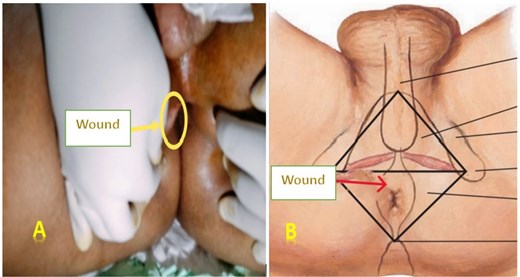 Images of the perineal wound located on the right anterolateral side. Legends: (A) Actual photograph of the perineal wound. (B) Illustrative image showing the wound location.