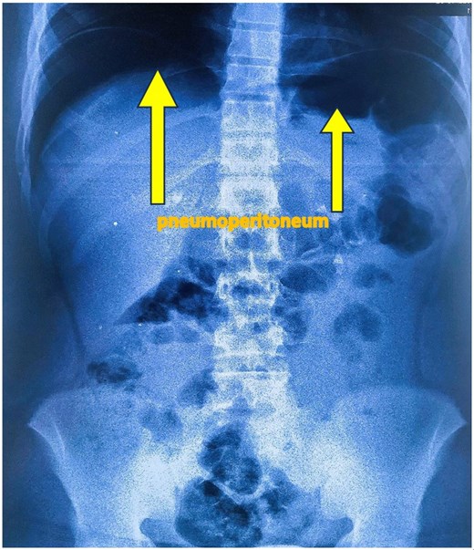 Standing abdominal plain X-ray showing large bilateral pneumoperitoneum.
