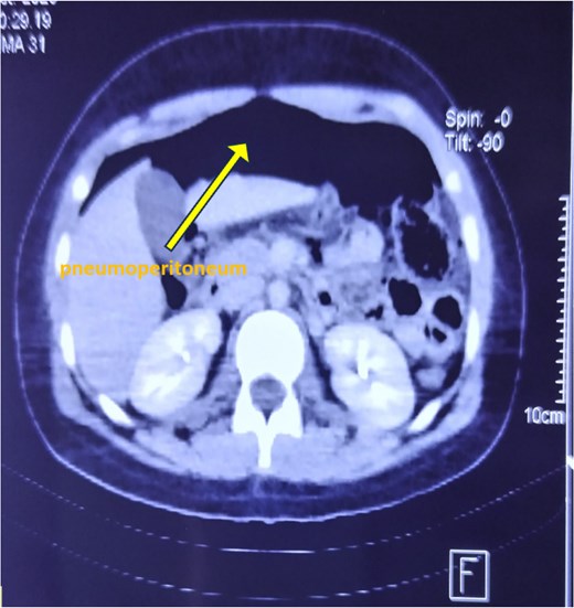 Axial CT scan of the abdomen showing extensive pneumoperitoneum.