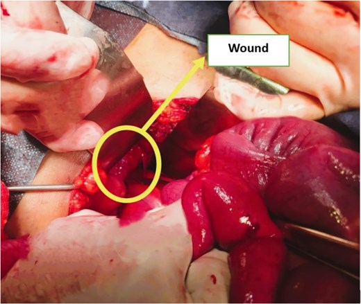 Intraoperative image showing a tear in the anterior fold of the peritoneal reflection of the pouch of Douglas.